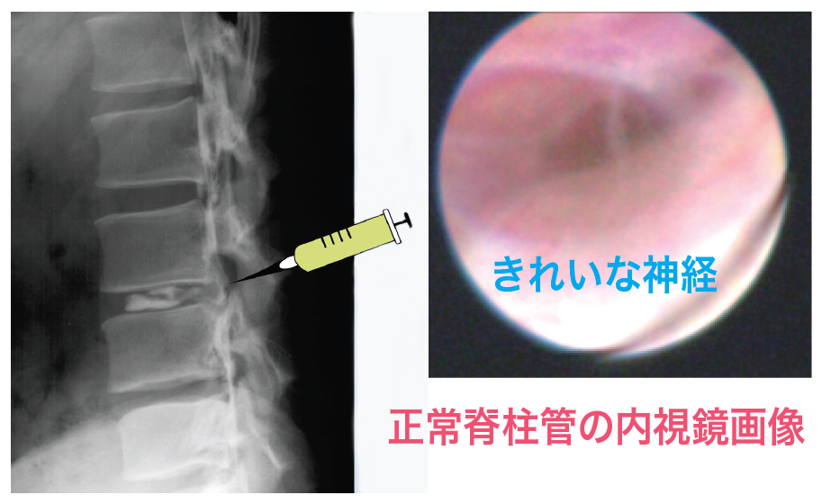 幹細胞上清液による椎間板内及び脊柱管内(硬膜外)修復治療