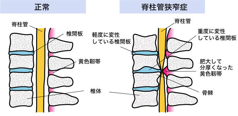 脊柱管狭窄症の原因